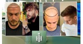 Hair of Istanbul-Υπηρεσίες μεταμόσχευσης μαλλιών