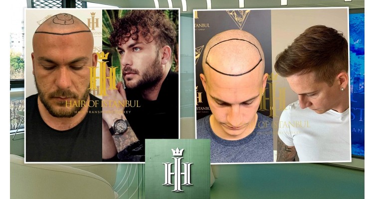 Hair of Istanbul-Υπηρεσίες μεταμόσχευσης μαλλιών
